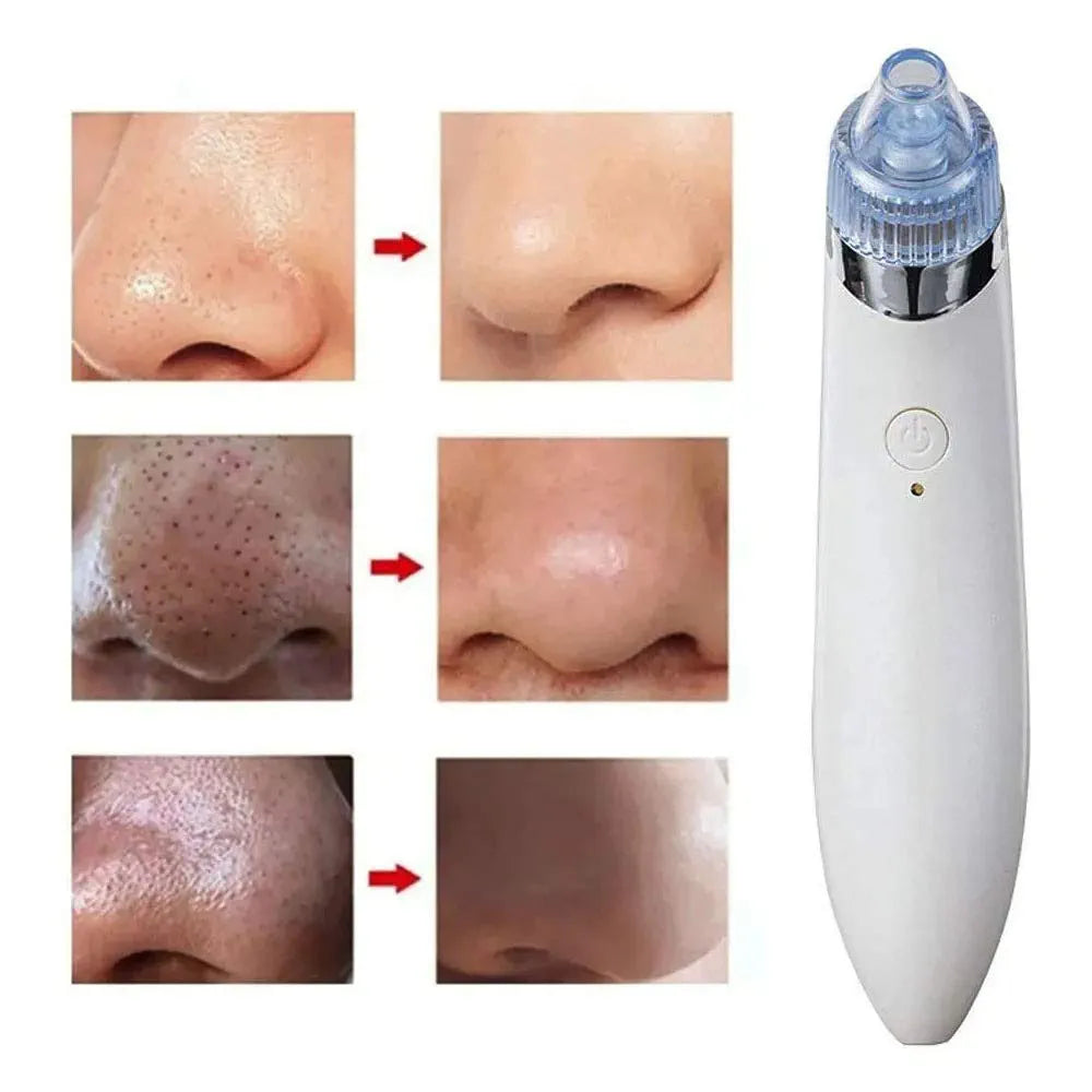 Aspirateur Point Noir Nettoyeur Visage Acné